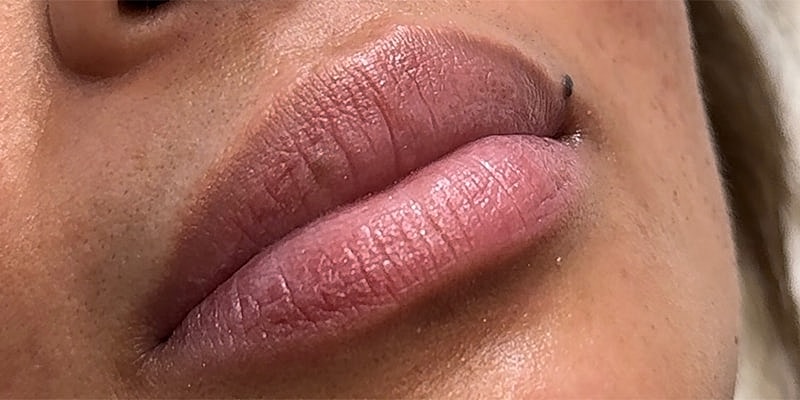 Lip Fillers Before & After