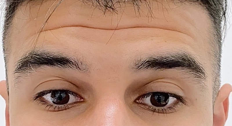 Botox Before & After