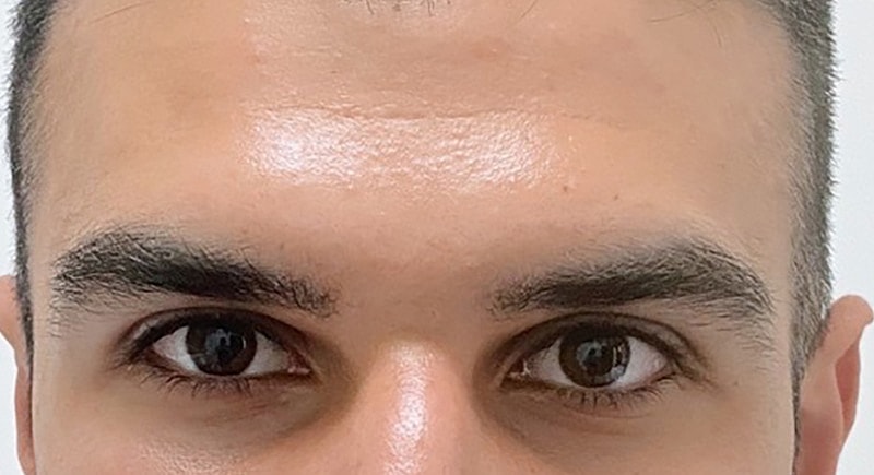 Botox Before & After