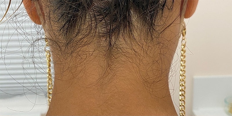 Laser Hair Removal Before & After