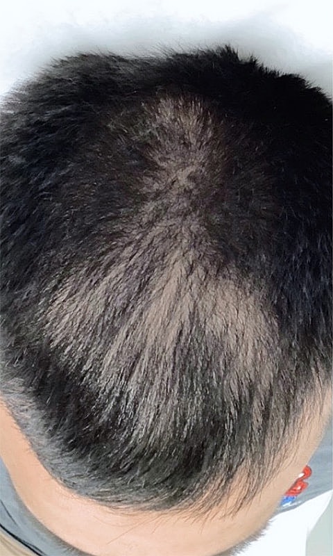 Hair Restoration With PRP Before & After