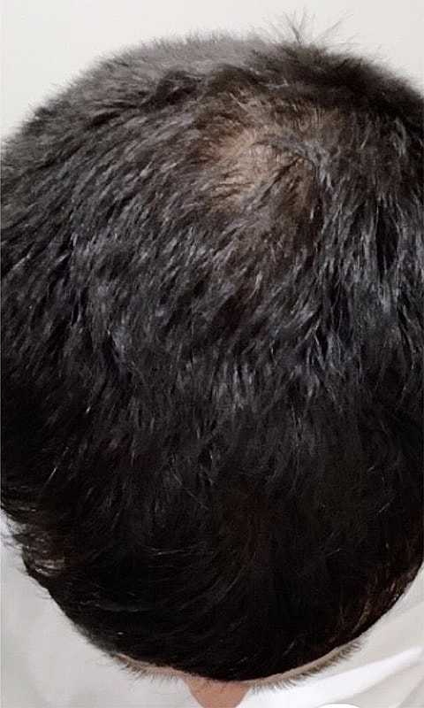 Hair Restoration With PRP Before & After