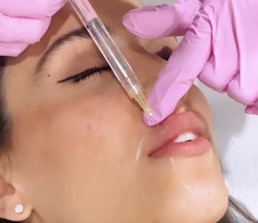 Toluca Lake med spa model with brown hair