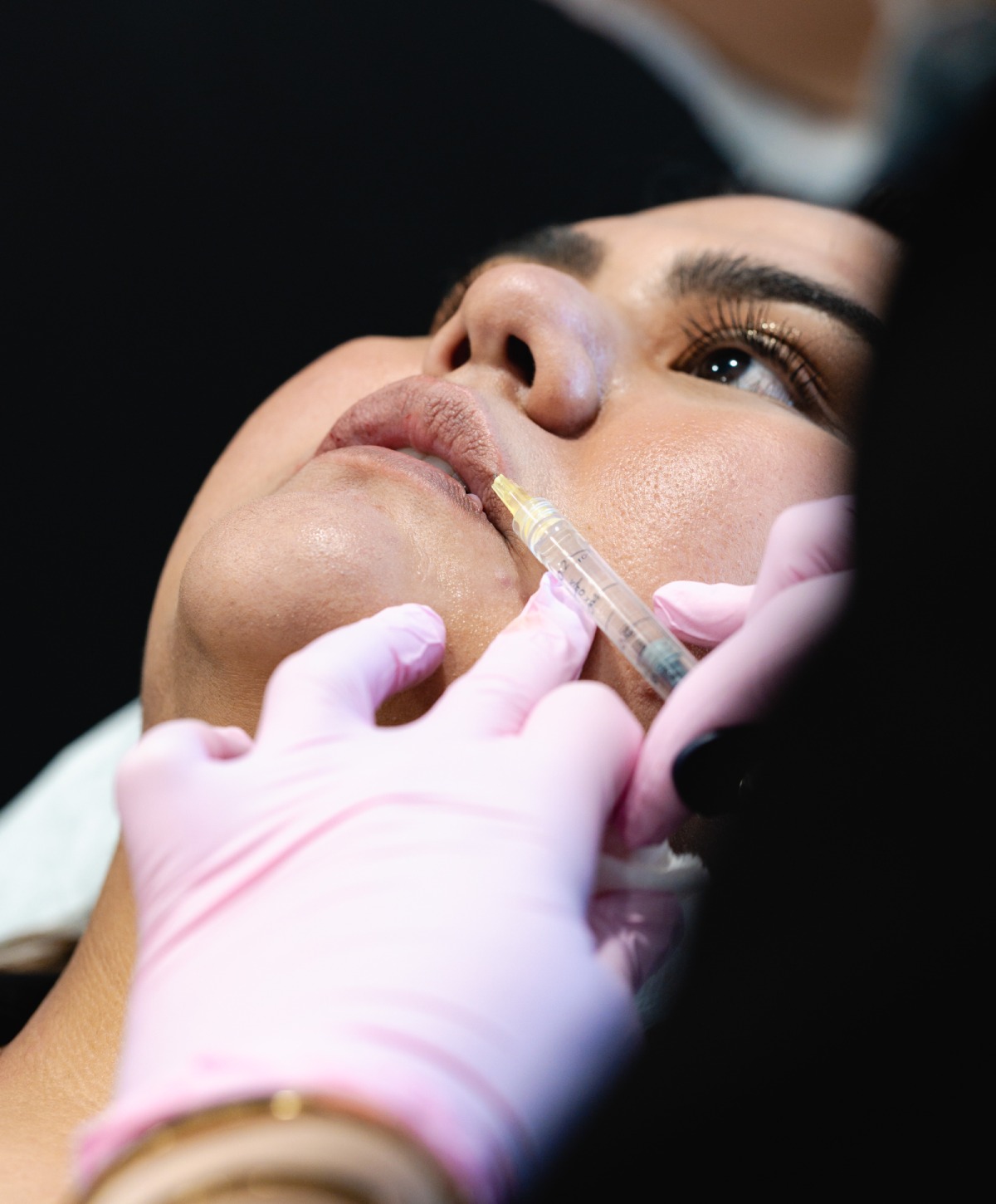 dermal fillers glendale