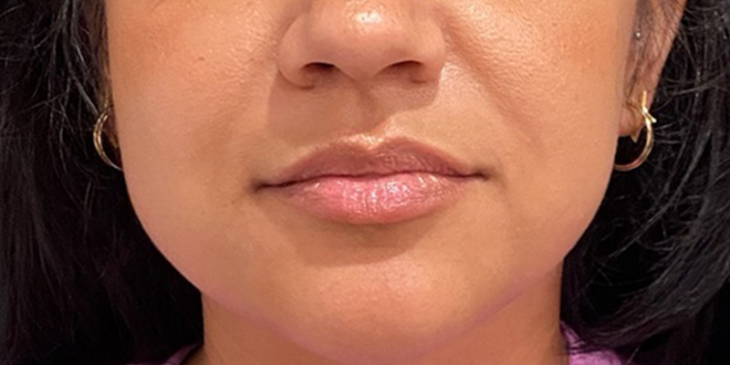 Lip Fillers Before & After Image