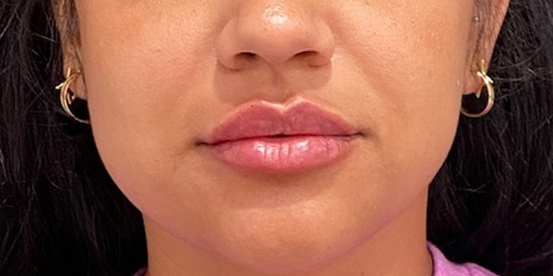 Lip Fillers Before & After Image