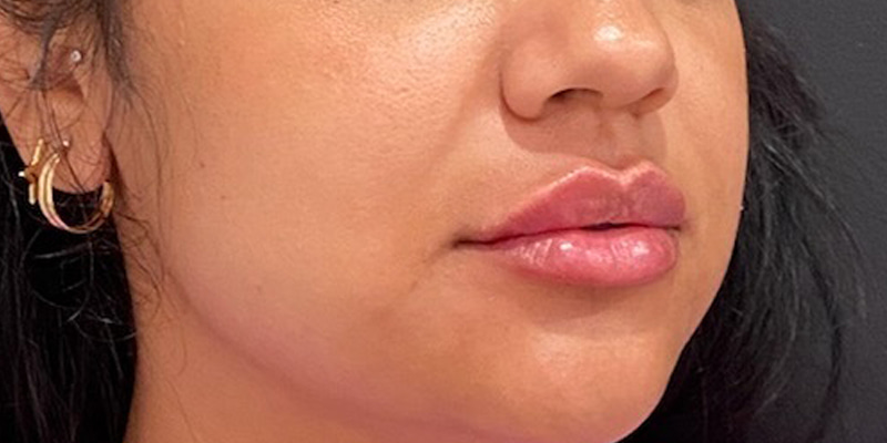 Lip Fillers Before & After Image