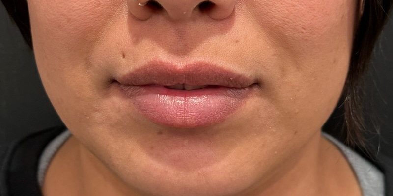 Lip Fillers Before & After Image