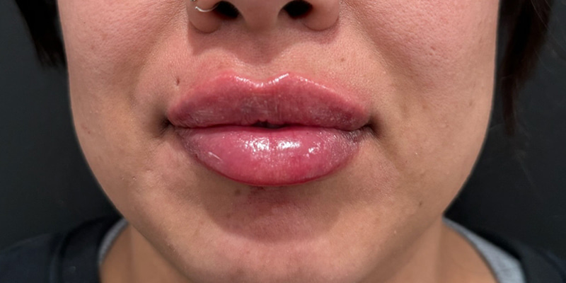 Lip Fillers Before & After Image