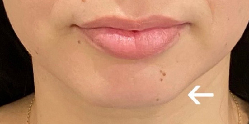 Lip Fillers Before & After Image