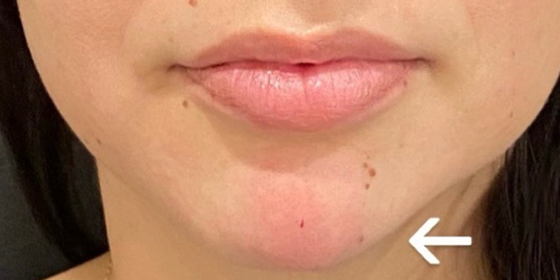 Lip Fillers Before & After Image