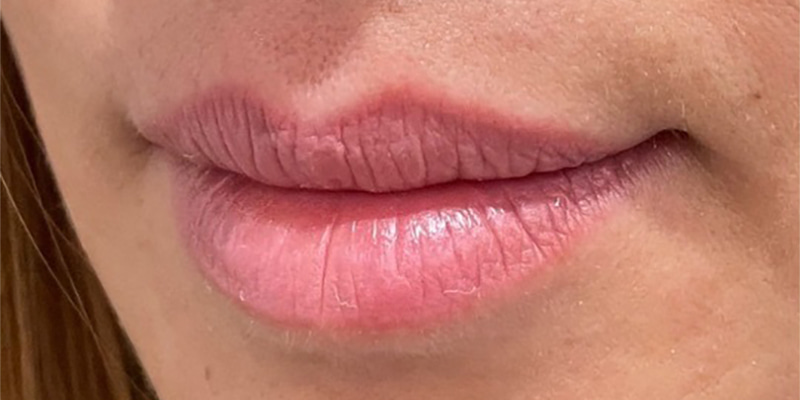 Lip Fillers Before & After Image