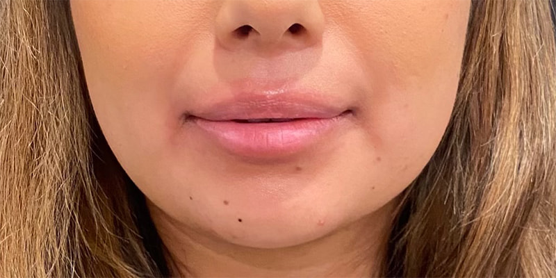 Lip Fillers Before & After Image