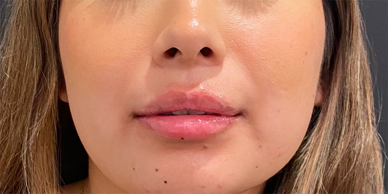 Lip Fillers Before & After Image