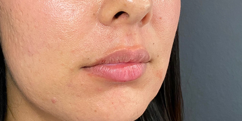 Lip Fillers Before & After Image