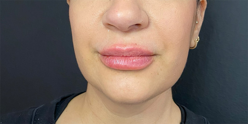 Lip Fillers Before & After Image